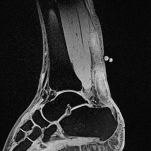 Bilateral Achilles tendon complete tear (Radiopaedia 81344-95051 Sagittal WE - Left 59).jpg