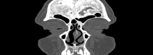 File:Bilateral Ectopic Infraorbital Nerves (Radiopaedia 49006-54084 Coronal bone window 1).jpg