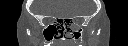 Bilateral Ectopic Infraorbital Nerves (Radiopaedia 49006-54084 Coronal bone window 47).jpg