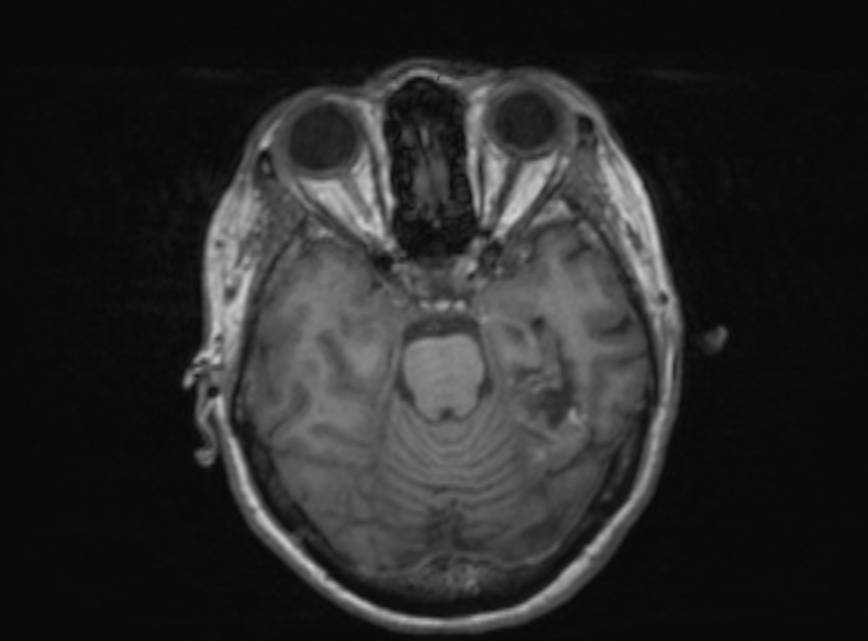 Bilateral PCA territory infarction - different ages (Radiopaedia 46200-51784 Axial T1 278).jpg