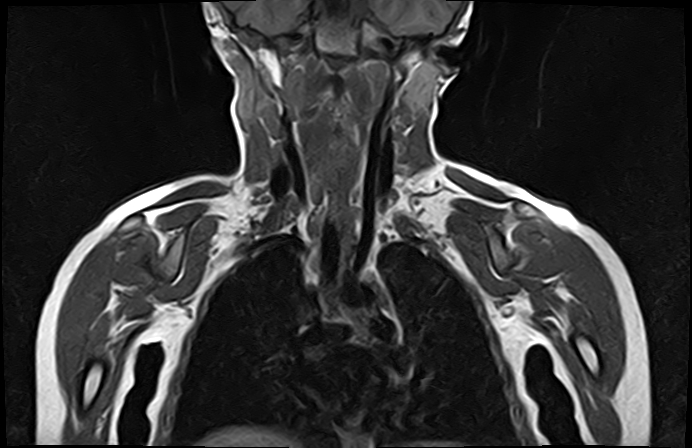 File:Bilateral Sprengel deformity with Klippel-Feil syndrome (Radiopaedia 66395-75650 Coronal T1 11).jpg