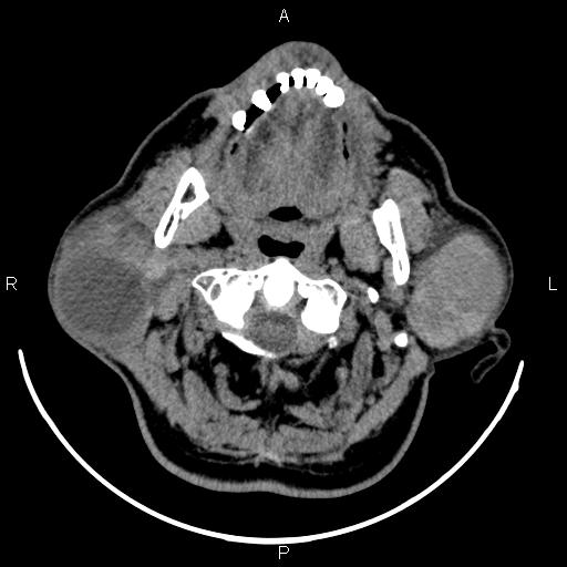 Bilateral Warthin tumors (Radiopaedia 84034-99263 Axial non-contrast 18).jpg