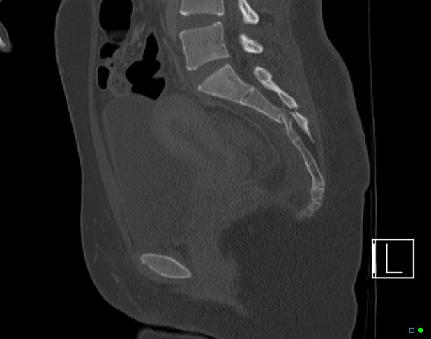 Bilateral acetabular fractures (Radiopaedia 79272-92308 Sagittal bone window 46).jpg