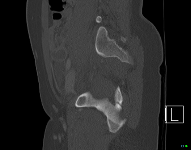 File:Bilateral acetabular fractures (Radiopaedia 79272-92308 Sagittal bone window 59).jpg