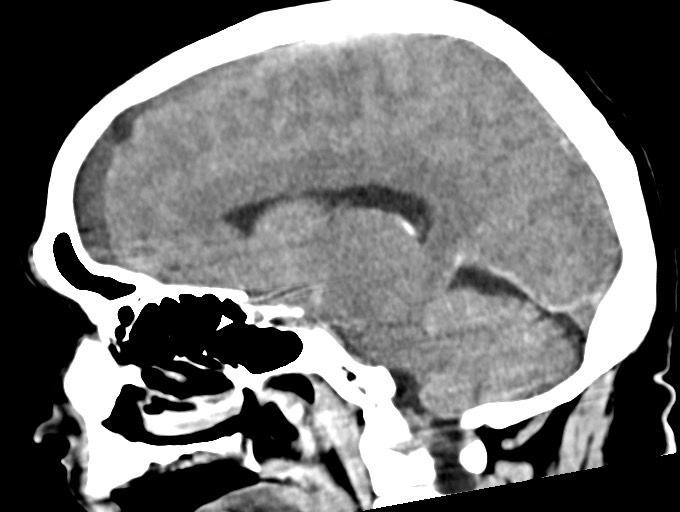 Bilateral acute on chronic subdural hematomas (Radiopaedia 78466-91146 C 27).jpg