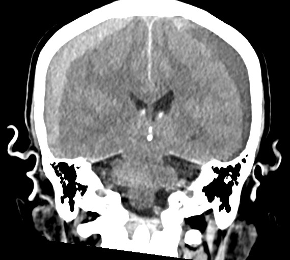 Bilateral acute on chronic subdural hematomas (Radiopaedia 78466-91146 Coronal non-contrast 43).jpg