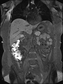 File:Bilateral adrenal myelolipoma (Radiopaedia 63058-71537 Coronal T1 fat sat 59).jpg