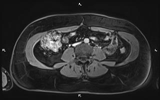 File:Bilateral adrenal myelolipoma (Radiopaedia 63058-71537 H 69).jpg