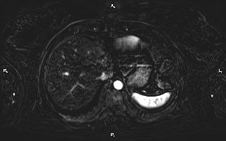 Bilateral adrenal myelolipoma (Radiopaedia 63058-71537 I 16).jpg