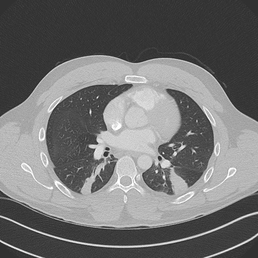 Bilateral atelectasis (Radiopaedia 48666-53675 Axial lung window 60).jpg