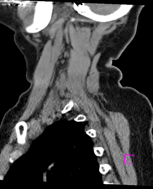 Bilateral atlanto-occipital assimilation (Radiopaedia 28350-28603 D 65).jpg