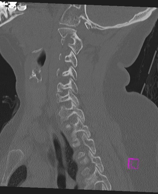 Bilateral atlanto-occipital assimilation (Radiopaedia 28350-28603 Sagittal bone window 50).jpg