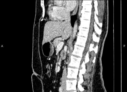 Bilateral benign adrenal adenomas (Radiopaedia 86912-103124 E 49).jpg