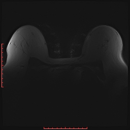 File:Bilateral breast implant rupture (Radiopaedia 24761-25027 PASTA Si 3).jpg
