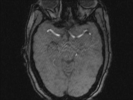 Bilateral carotid body tumors and right glomus jugulare tumor (Radiopaedia 20024-20060 Axial MRA 338).jpg