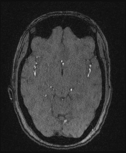Bilateral carotid body tumors and right glomus jugulare tumor (Radiopaedia 20024-20060 Axial MRA 80).jpg