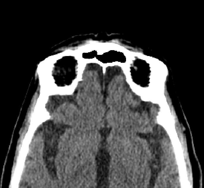 Bilateral ectopia lentis (Radiopaedia 89889-107013 Axial non-contrast 7).jpg