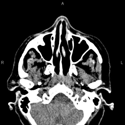 File:Bilateral enlargement of lacrimal glands - sarcoidosis (Radiopaedia 62627-70921 Axial non-contrast 16).jpg