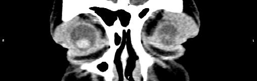 File:Bilateral enlargement of lacrimal glands - sarcoidosis (Radiopaedia 62627-70921 Coronal non-contrast 7).jpg