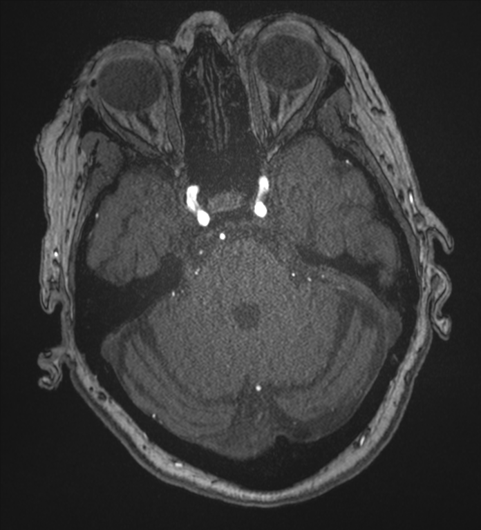 Bilateral fetal posterior communicating arteries (Radiopaedia 41286-44102 Axial MRA 55).png