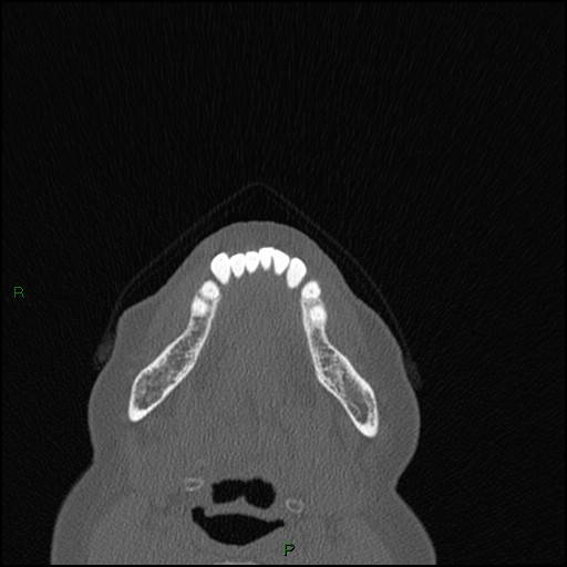 Bilateral frontal mucoceles (Radiopaedia 82352-96454 Axial bone window 311).jpg