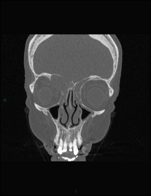 Bilateral frontal mucoceles (Radiopaedia 82352-96454 Coronal 108).jpg