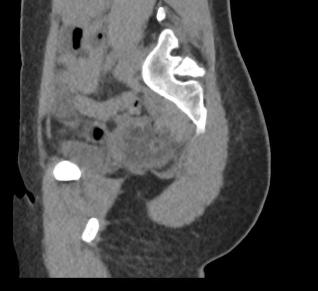 Bilateral mature cystic ovarian teratoma (Radiopaedia 88821-105592 D 52).jpg