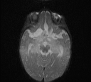File:Bilateral optic pathway gliomas (Radiopaedia 40013-42514 Axial DWI 6).jpg