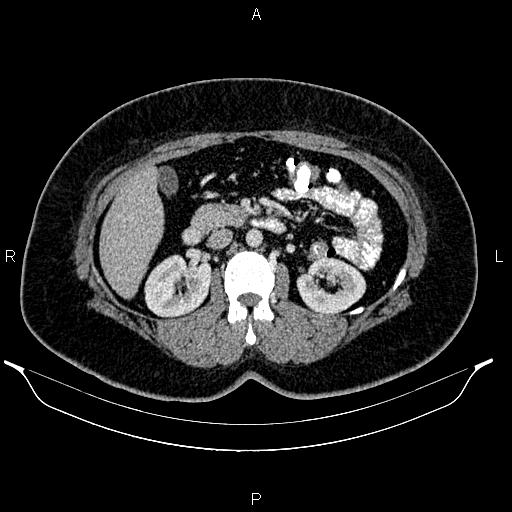 Bilateral ovarian dermoid cysts (Radiopaedia 85785-101603 A 46).jpg