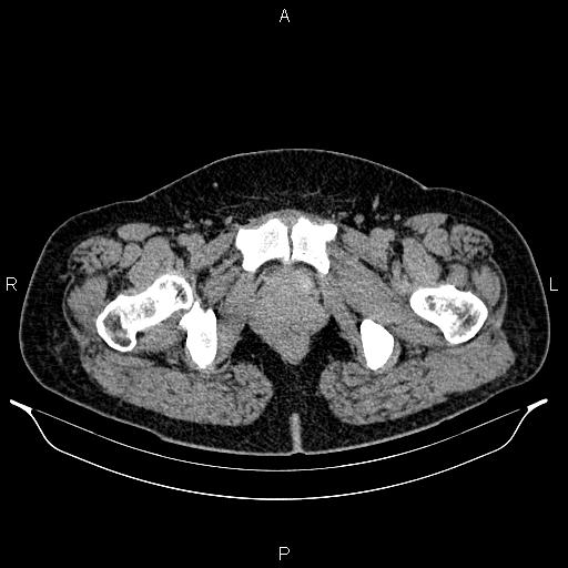 Bilateral ovarian dermoid cysts (Radiopaedia 85785-101603 Axial C+ delayed 89).jpg