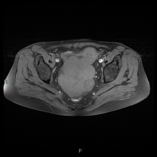 File:Bilateral ovarian fibroma (Radiopaedia 44568-48293 Axial T1 fat sat 16).jpg