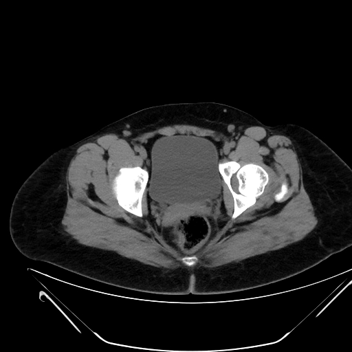 File:Bilateral ovarian mature cystic teratomas (Radiopaedia 79373-92457 Axial non-contrast 81).jpg