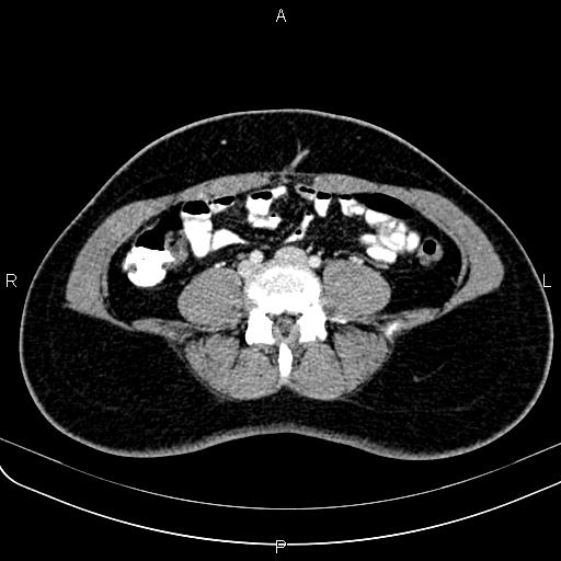 File:Bilateral ovarian teratoma (Radiopaedia 83131-97503 Axial With contrast 1).jpg