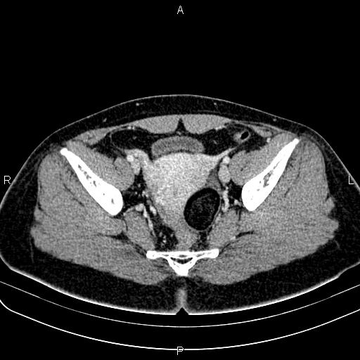 Bilateral ovarian teratoma (Radiopaedia 83131-97503 Axial With contrast 45).jpg