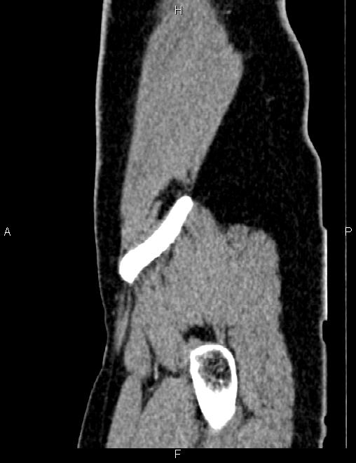 Bilateral ovarian teratoma (Radiopaedia 83131-97503 D 21).jpg