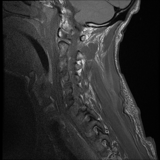 File:Bilateral perched facets with cord injury (Radiopaedia 45587-49714 Sagittal T1 12).jpg