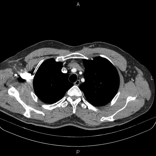 Bilateral pulmonary AVM (Radiopaedia 83134-97505 A 16).jpg