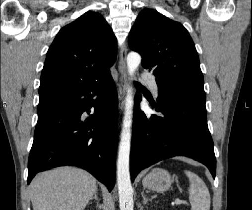 Bilateral pulmonary AVM (Radiopaedia 83134-97505 C 46).jpg