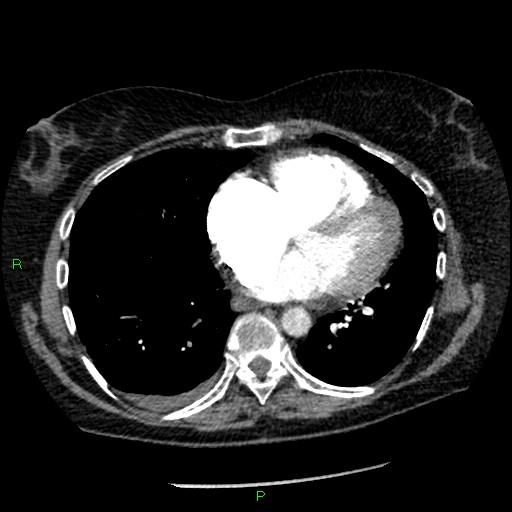 Bilateral pulmonary emboli (Radiopaedia 32700-33669 Axial C+ CTPA 71).jpg