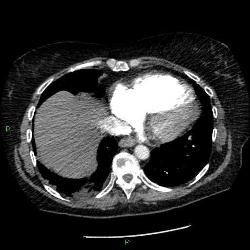 Bilateral pulmonary emboli (Radiopaedia 32700-33669 Axial C+ CTPA 83).jpg
