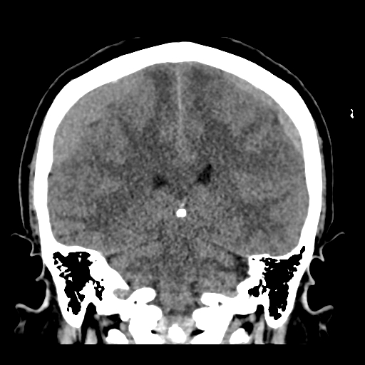 Bilateral subacute subdural hematoma (Radiopaedia 69240-79018 Coronal non-contrast 36).jpg