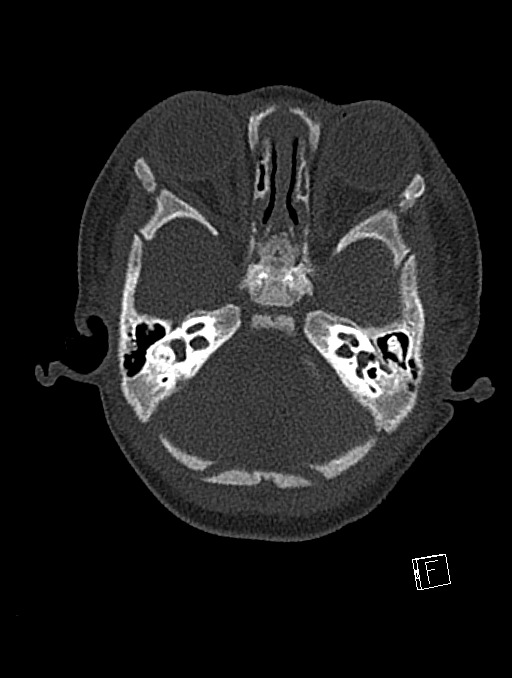Bilateral subdural hemorrhage and parietal skull fracture (Radiopaedia 26058-26192 Axial bone window 107).png