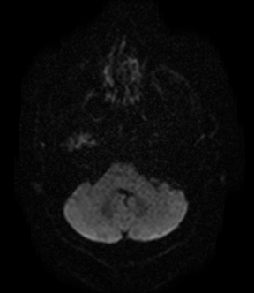 File:Bilateral thalamic glioma (Radiopaedia 65852-75009 Axial DWI 4).jpg