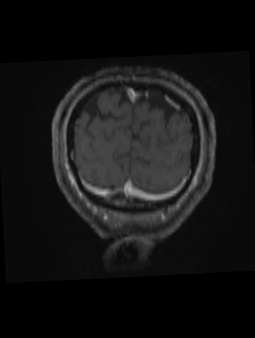 File:Bilateral thalamic glioma (Radiopaedia 65852-75009 Coronal T1 C+ 23).jpg