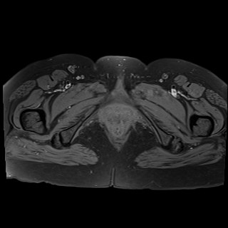 Bilateral tubo-ovarian abscesses (Radiopaedia 58635-65829 Axial T1 fat sat 46).jpg
