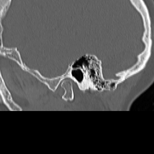 Bilateral tympanoplasty (Radiopaedia 16947-16664 Sagittal bone window 13).jpg