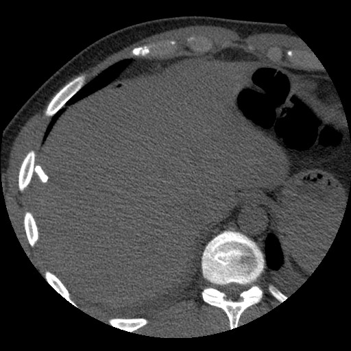 File:Bile leak from liver traumatic laceration (Radiopaedia 63463-72077 Axial Biliscopin 17).jpg