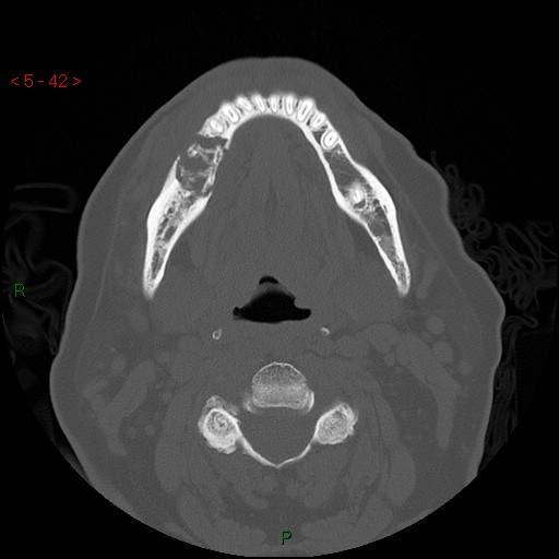 Bisphosphonate-related osteonecrosis of the jaw (Radiopaedia 54147-60329 Axial bone window 36).jpg