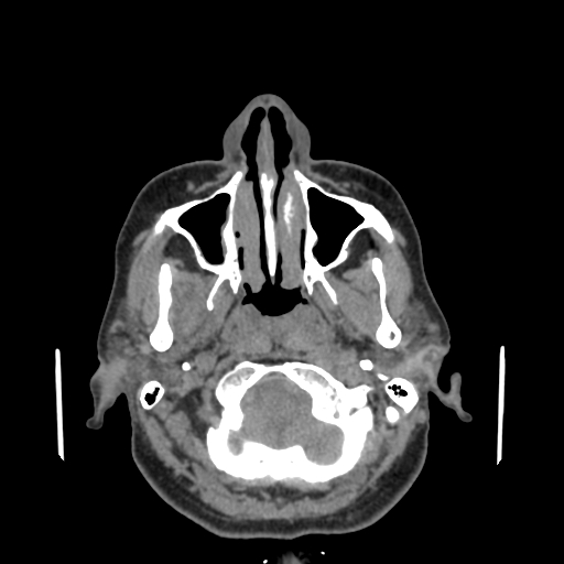 Bisphosphonate-related osteonecrosis of the jaw (Radiopaedia 71324-81642 non-contrast 130).jpg