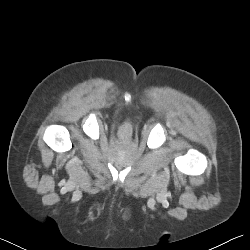 File:Bladder papillary urothelial carcinoma (Radiopaedia 48119-52951 Axial C+ delayed 63).png